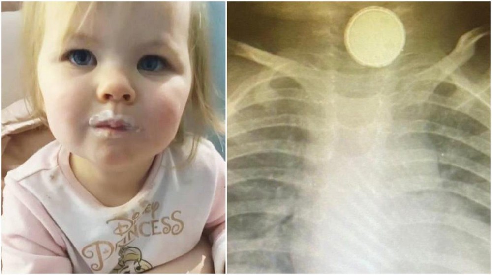 FOTO/VIDEO: O fetiță de nici un an a stat 4 luni cu o baterie în gât. Iniţial, medicii au crezut că are amigdalită
